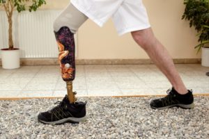 Knee Prosthesis